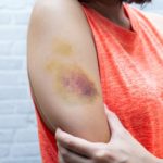 Bruise on woman arm. Injection bruises. Doctor and patient.