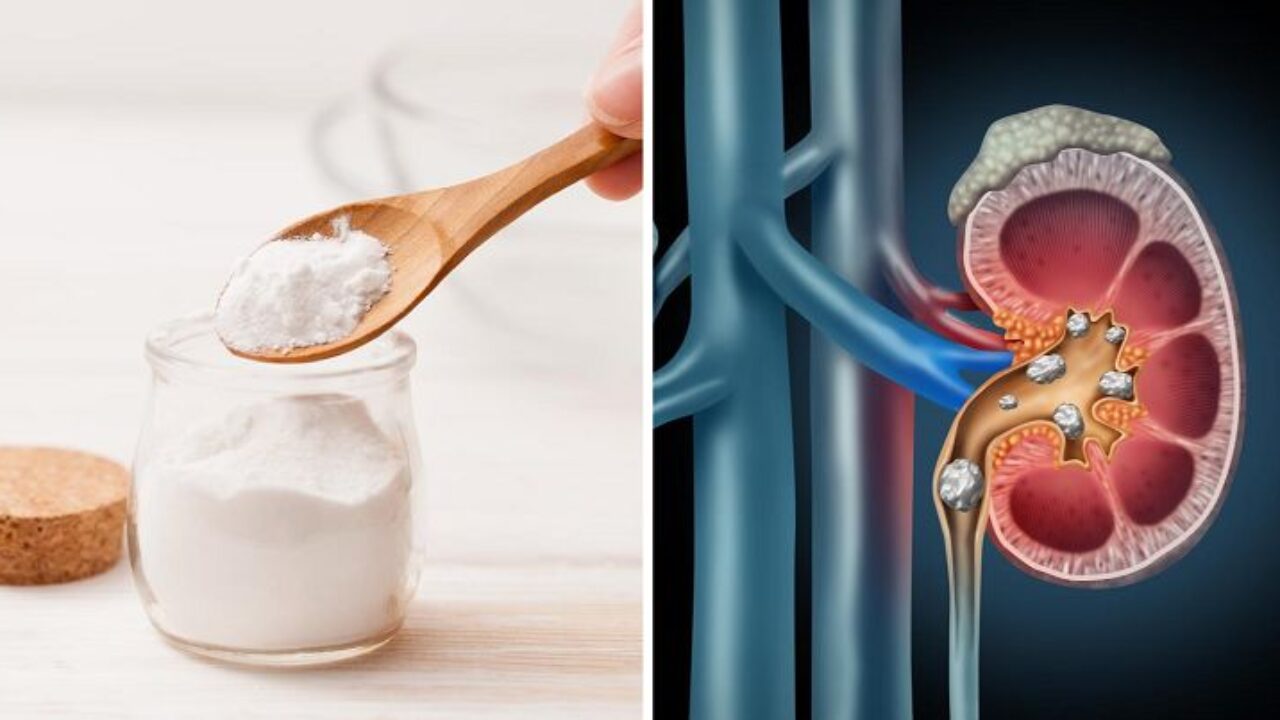 Mangiare 1 2 Cucchiaino Di Bicarbonato Di Sodio Ogni Giorno Puo Essere Benefico Per I Tuoi Reni Il Mondo Delle Donne