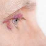 Injured eye due to capillary rupture