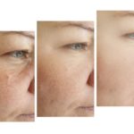 woman face wrinkles before and after treatment