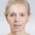 Before and after skin treatment