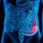 3d illustration of colon cancer – colon tumor