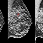 radiografia mammaria