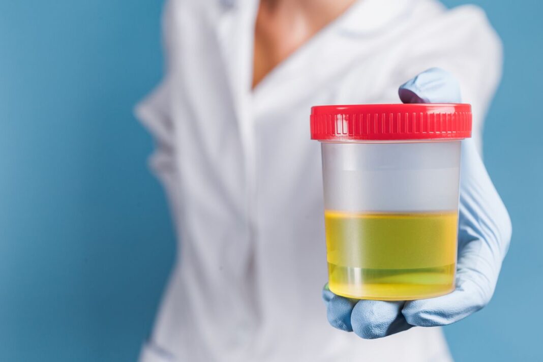 Se la tua urina è di questo colore, chiama il tuo medico Il Mondo